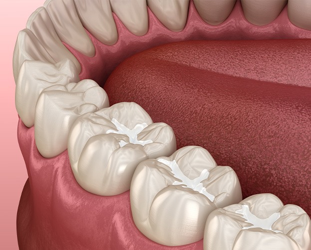 Animated smile after dental sealant placement